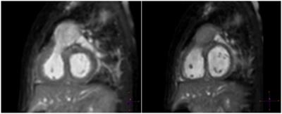 3D Whole Heart Imaging for Congenital Heart Disease